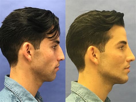 How To Get A Defined Jawline A Guide To Cosmetic Surgery Injectable