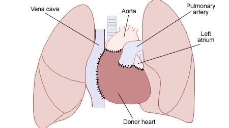 The successful liver transplant program. Scientists a step closer to pig hearts for humans | The ...