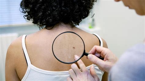 Melanoma ‘my Pimple Turned Out To Be Cancer