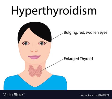Enlarged Thyroid Women