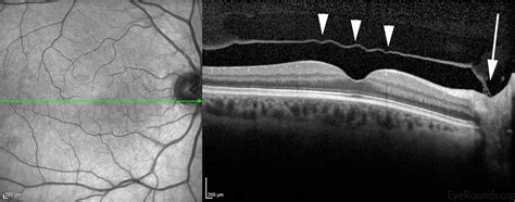 Posterior Vitreous Detachment