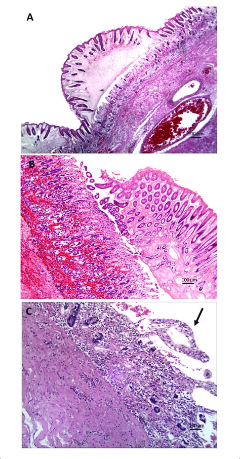 Photomicrographs Of Tissue Sections With Clostridial Infection In The