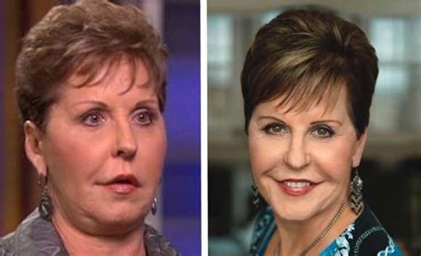 Did Joyce Meyer Undergo Plastic Surgery Including Facelift And Lips Famous Plastic Surgeries