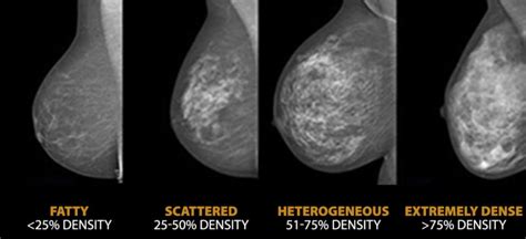 Breast Density Does It Really Matter Life Among Women
