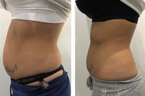 Jump to navigation jump to search. Ultrasound Cavitation | Ice Lipo Clinic