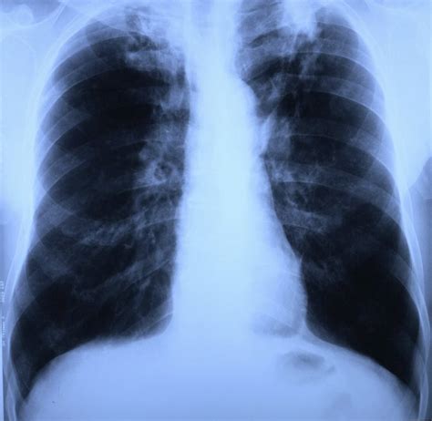 Diagnosing Chronic Pulmonary Aspergillosis In Treated Pulmonary Tb