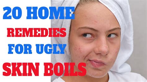 Best Way To Treat Boils Get Rid Of Skin Boils Fast Carbuncle