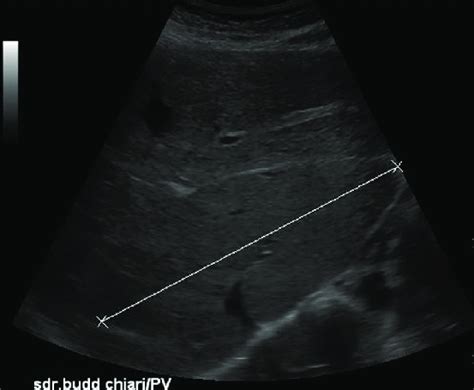 Ultrasound Examination Of The Liver In Sagittal Section Important