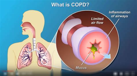 Understanding Copd And How Medical Oxygen Can Help