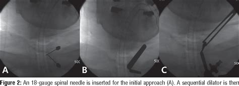 Figure From Posterior Percutaneous Endoscopic Cervical Foraminotomy And Diskectomy With