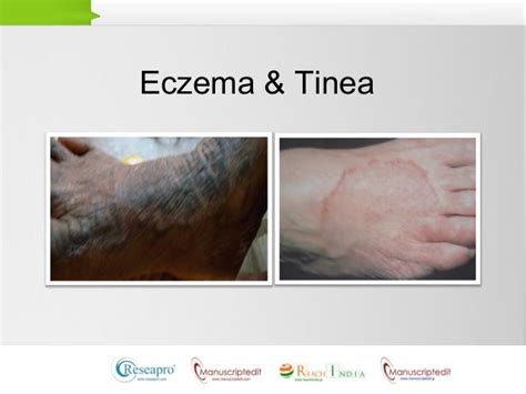 Eczemas Part 2