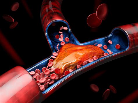 Diagnostic Tools For Deep Vein Thrombosis And Pulmonary Embolism