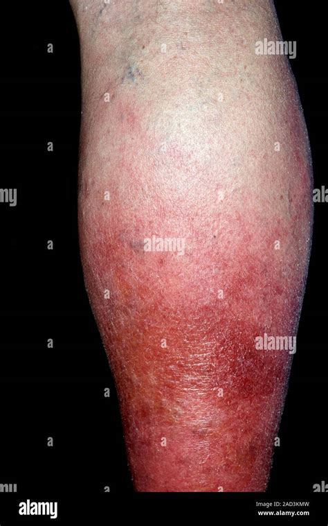 Cellulitis Following Toe Injury Close Up Of The Swollen Lower Leg Of A