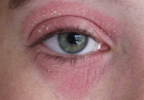 Painful Red Rash Under Eyes Bing Images Dry Skin Around Eyes Dry