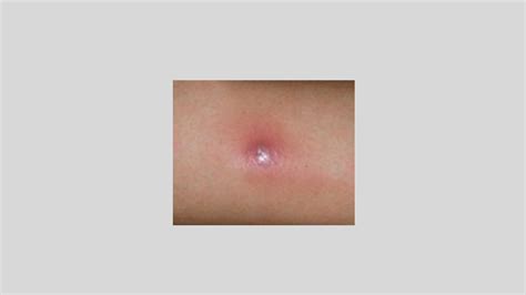 Mrsa Staph Infection Pictures Symptoms And Risk Factors