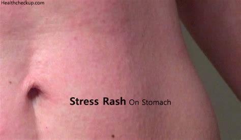 Skin Rash On Stomach