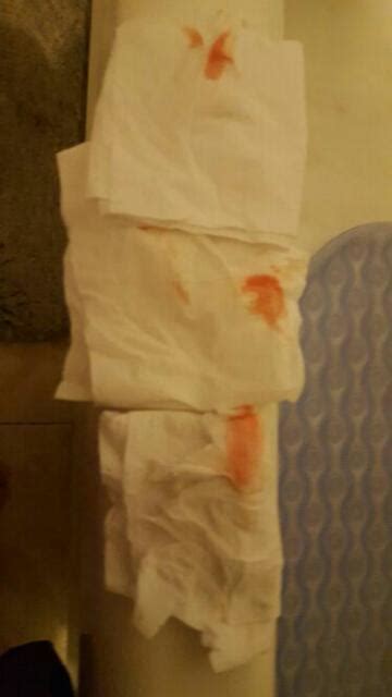 Medically reviewed by carolyn kay, m.d. Breakthrough Bleeding