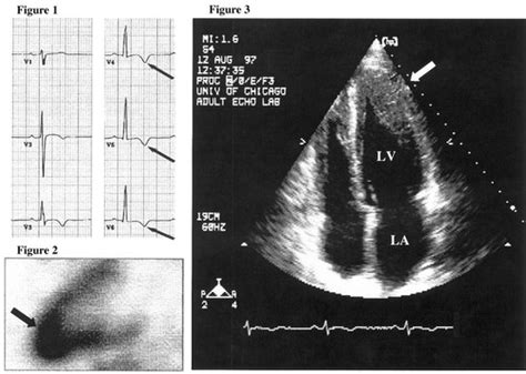 Apical Hypertrophic Cardiomyopathy Circulation