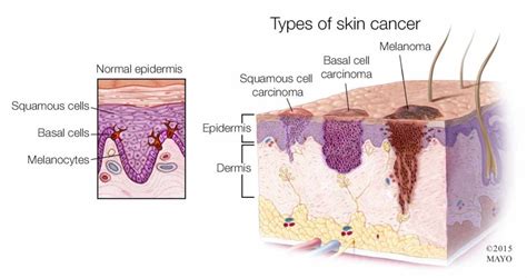 Skin Cancer And Melanoma Causes Symptoms Treatment Health Life Media