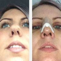We did not find results for: Deviated Septum Before And After » Rhinoplasty: Cost, Pics ...