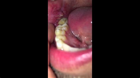 Infection After Wisdom Teeth Removal Youtube