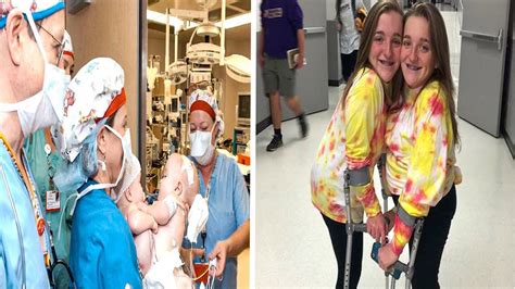 Formerly Conjoined Twins Finally Share Their Journey 18 Years After