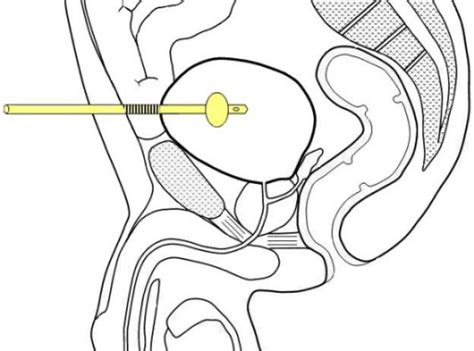 Suprapubic Catheter Traverse Through A Small Bowel Loop Between The