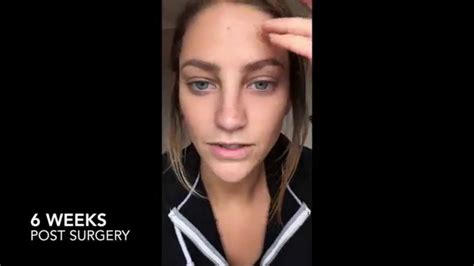 Vlog 8 6 Weeks Post Surgery Rhiannon Langley Rhiannongetsrhino Youtube