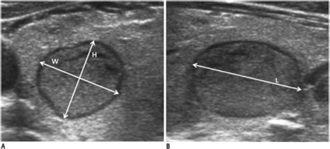 Thyroid Nodule Diameters Measured By Using Ultrasonogra Open I