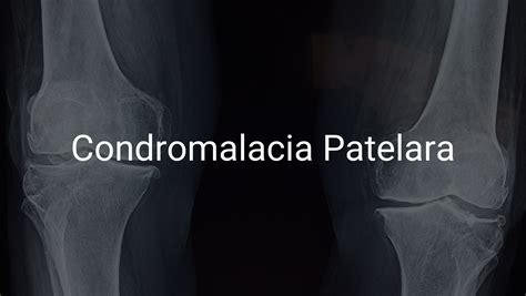 Condromalacia Patelara Ce Este Si Cum Se Trateaza Consultatie Ortopedie