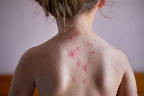 Review the symptoms of chickenpox, a viral infection that is becoming less common because most children now receive the chickenpox vaccine. Chickenpox - myDr.com.au