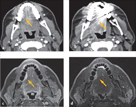 7 Imaging Of Oral Cavity Cancers Pocket Dentistry