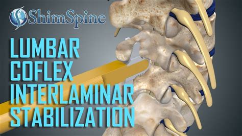 Lumbar Coflex Interlaminar Stabilization Surgery Youtube
