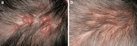 Clinical Picture Of A Primary Cutaneous Follicle Center Lymphoma