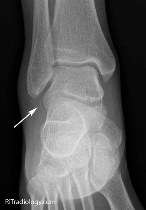 Rit Radiology Fracture Of The Lateral Process Of Talus
