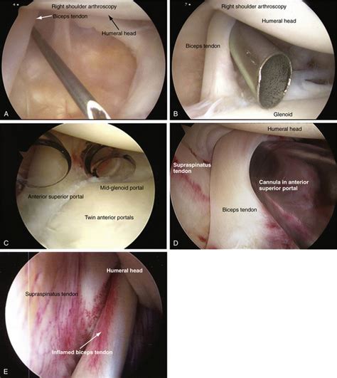 We did not find results for: Diagnostic Shoulder Arthroscopy and Bursoscopy ...