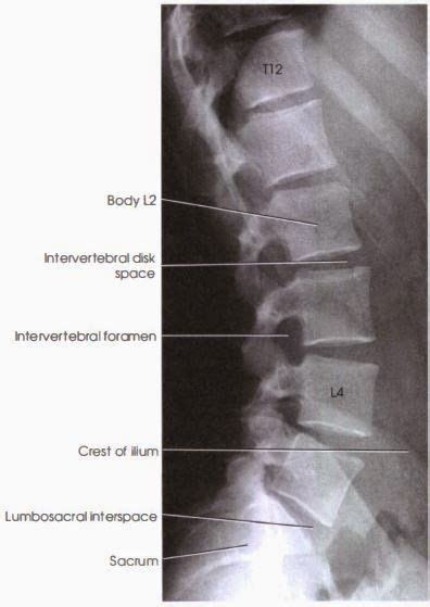 Lateral Lumbar Spine X Ray Labeled