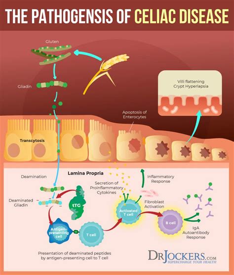 Celiac Disease Symptoms Causes And Natural Support Strategies Celiac