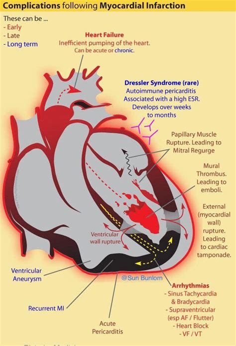 Complications Following Myocardial Infarction Heart Grepmed