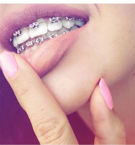 braces teeth colors pink braces cute braces colors teeth braces braces tips getting braces