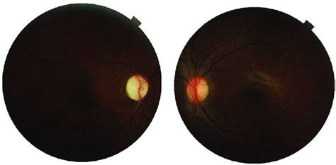 Fundus Photograph Of Both Eyes At The End Of 1 Year Follow Up Optic