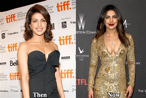 Priyanka Chopra Plastic Surgery Before And After Photos Latest Plastic Surgery Gossip And News
