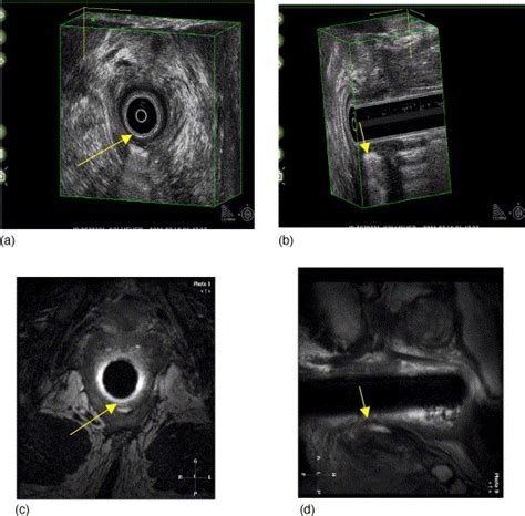 Endoanal Ultrasound In Perianal Fistulas And Abscesses Digestive And Liver Disease