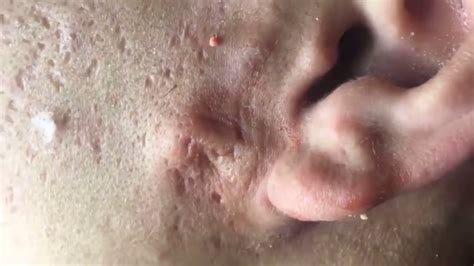 Pus And Blood Coming Out Cyst Whiteheadsblackheads From Face Removal