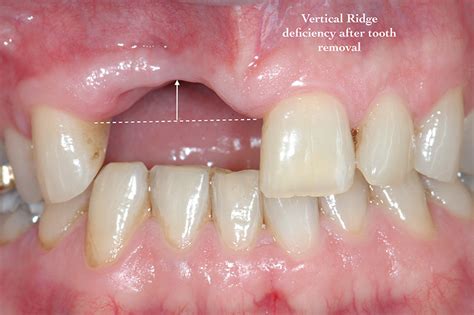 We did not find results for: Periodontal Disease and Bone Loss Case Study - Shaun ...