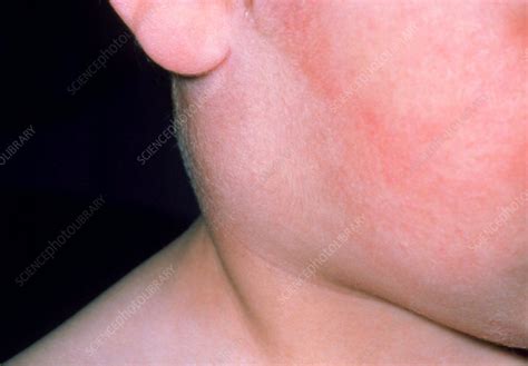 Inflamed Parotid Gland Child With Mumps Stock Image M2100101