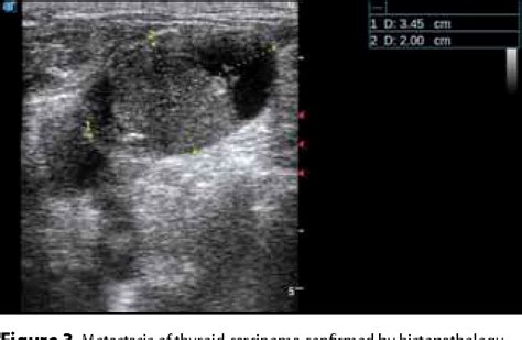 Figure 3 From Ultrasonography Of Head And Neck Lymph Nodes Performed By