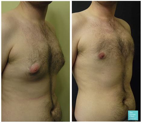 Nipple Correction Surgery Reduction Of Areola Bilateral Inverted