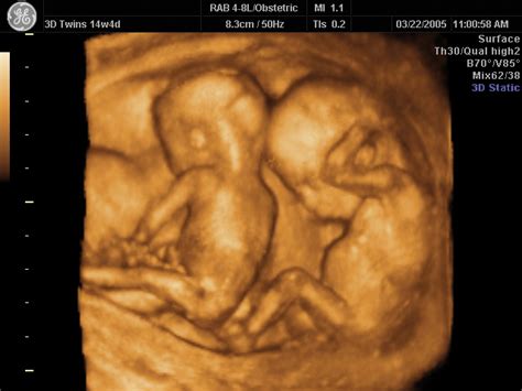 embarazo múltiple ¿gemelos mellizos trillizos o más