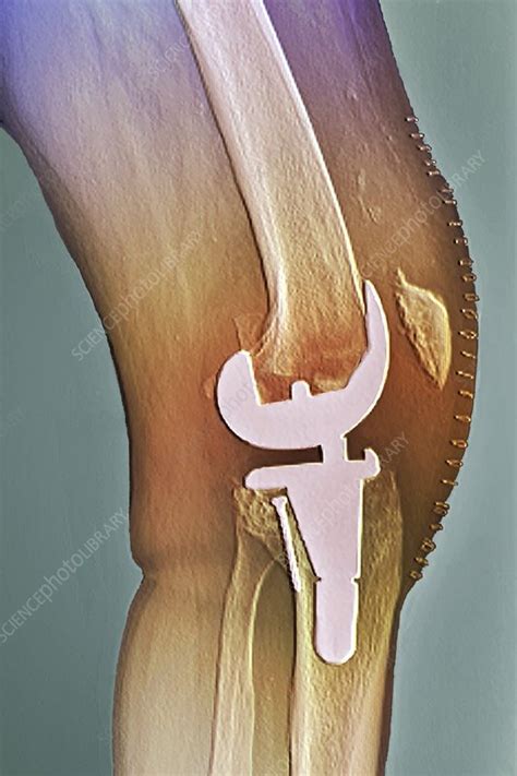 Total Knee Replacement X Ray Stock Image C0041478 Science Photo